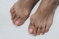 Understanding Bunions and Their Causes